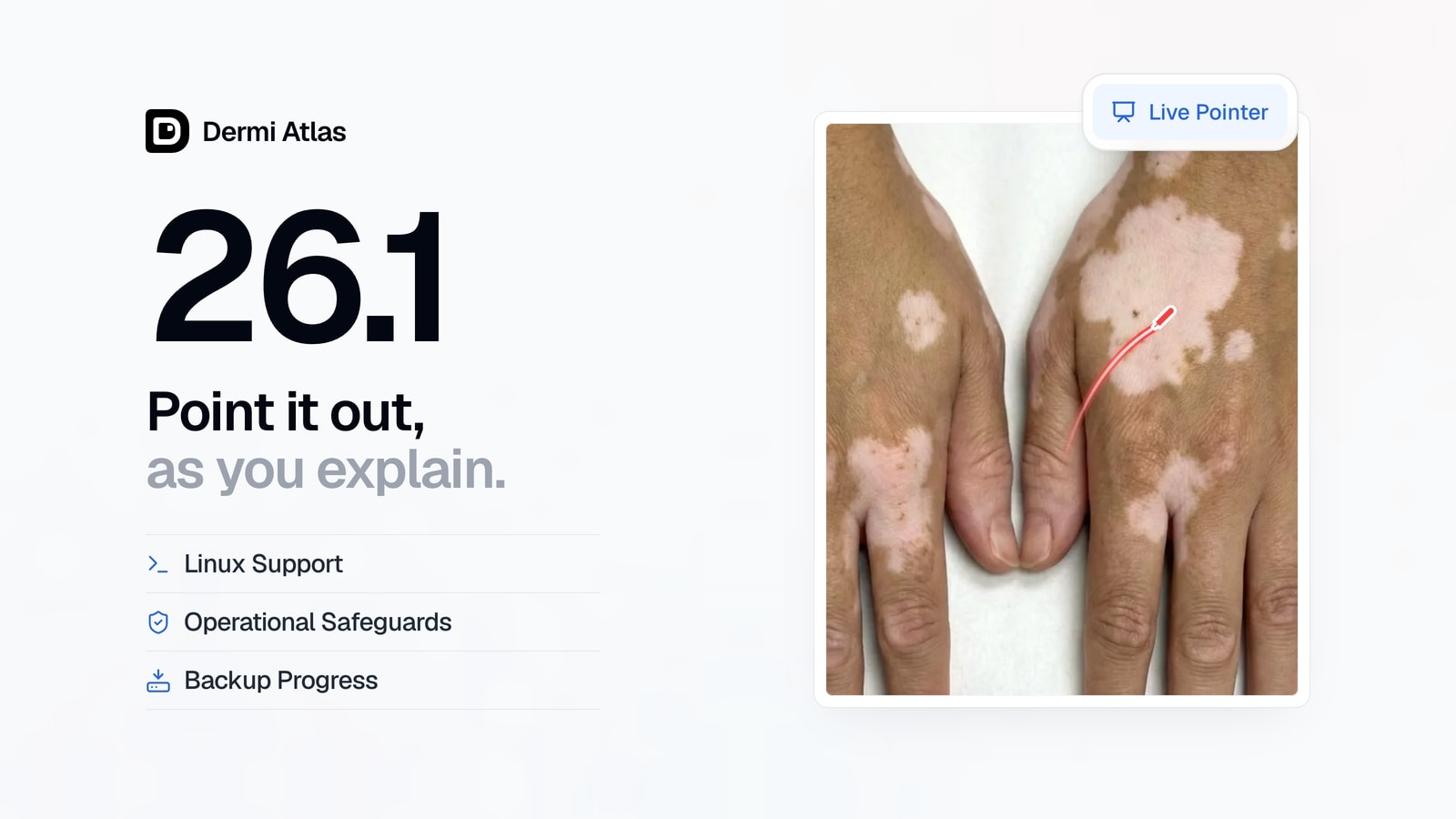 Hands with vitiligo and a Live Pointer stroke across a depigmented patch