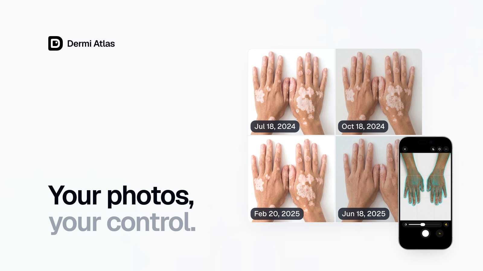 Four visits of the same hands in a comparison grid, each labeled with its date, beside Dermi Atlas Companion on iPhone capturing the hands with the previous visit as an alignment guide