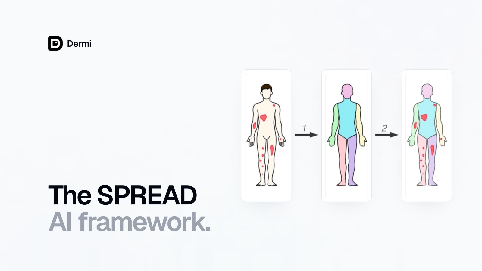 Three stages from the SPREAD framework figure: a body illustration with lesions, the body segmented by region, and the segmented body with lesions
