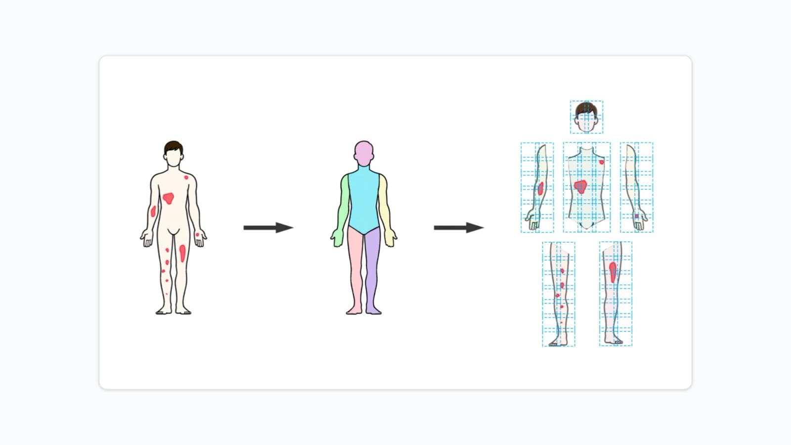 Multi-stage AI pipeline for full-body dermatological image analysis